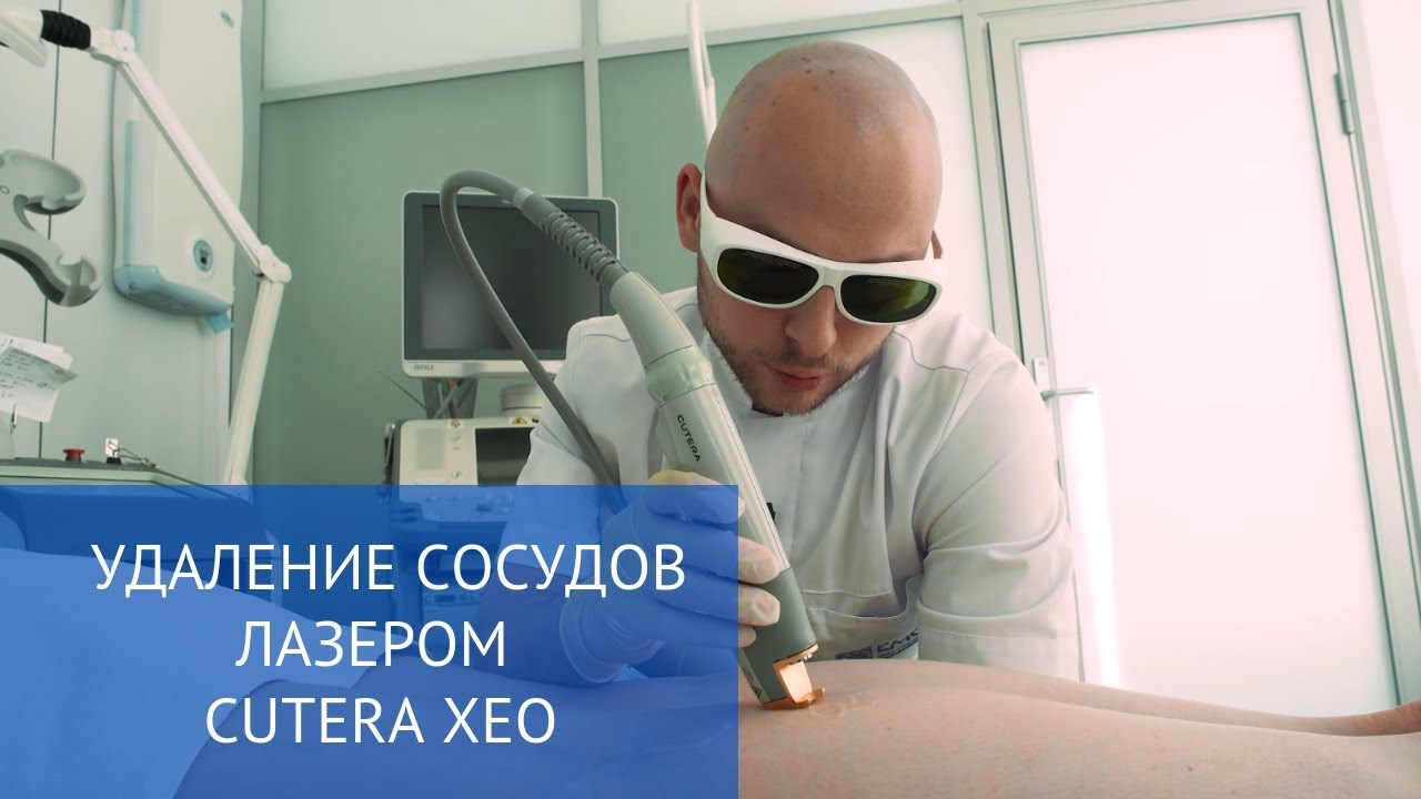 Удаление сосудов лазером Cutera XEO